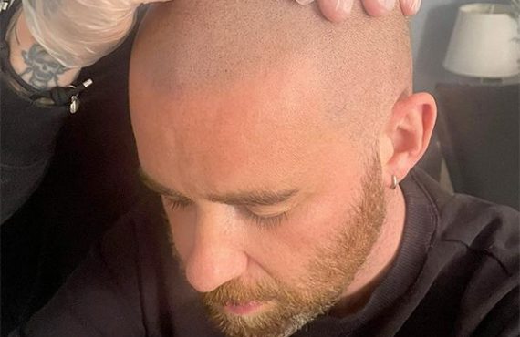 Scalp Micropigmentation vs Hair Transplant