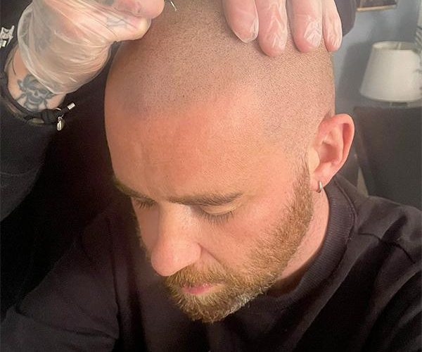 Scalp Micropigmentation vs Hair Transplant