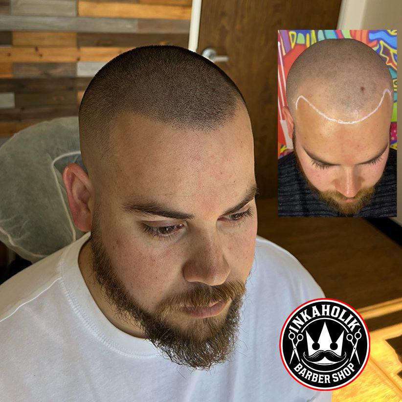 Scalp Micropigmentation Miami